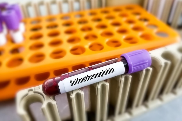 Sulfmethemoglobine-bloedtest Het complex gevormd door de reactie van een sulfidehemoglobine en zuurstof