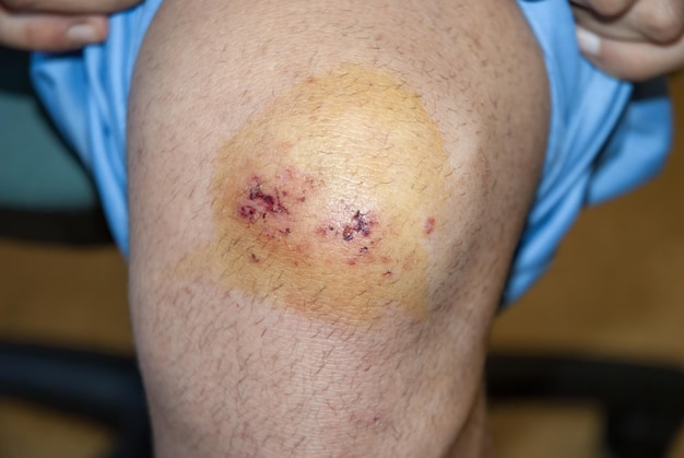 Photo superficial skin erosions in the knee resulting from a fall