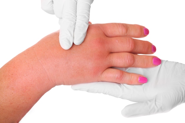 a swollen hand due to a wasp sting being examined by a doctor over white