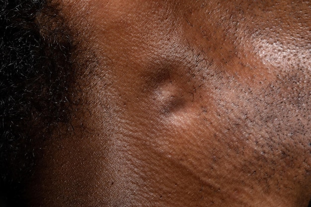 Swollen lymph nodes in the neck of an African man