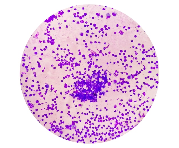 Synoviale vloeistofcytologie met veel WBC om artritis te diagnosticeren.