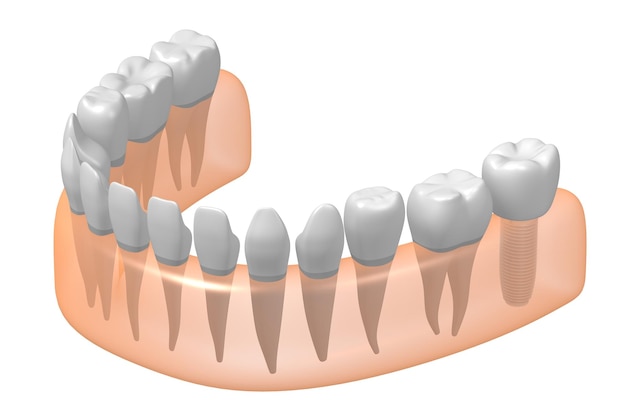 Foto tand implantaat andere gezonde en tandvlees 3d illustratie