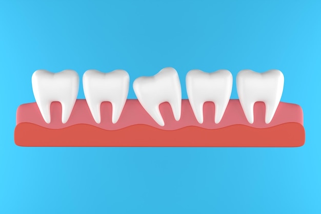 Tand met orthodontische beugelset