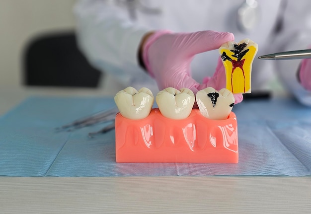 Tandarts met een model van tandanatomie Orale caries en tandziekten en schrapen van tandsteen concept
