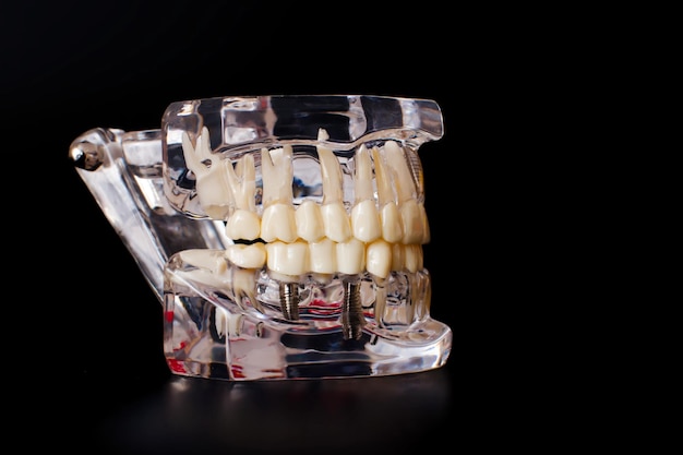 Tandarts tandheelkundige prothetische tanden tandvlees wortels close-up studeren tandheelkundige ziekten concept