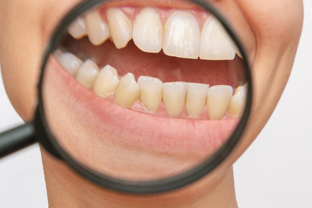 Tanden van jonge vrouw met tandsteen en gele plaque vergroot in een vergrootglas