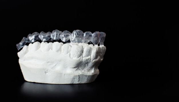 Tandheelkundig kaakmodel op zwarte achtergrond Transparante onzichtbare tandheelkundige aligners of beugels die van toepassing zijn op een orthodontische tandheelkundige behandeling