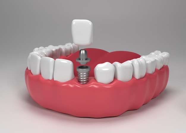 Tandheelkundige implantaten chirurgie 3D-rendering