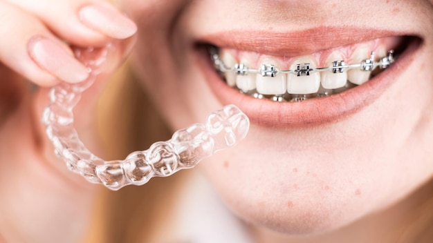 Tandheelkundige zorg Glimlachend meisje met beugels op haar tanden houdt aligners in haar handen en laat het verschil tussen hen zien