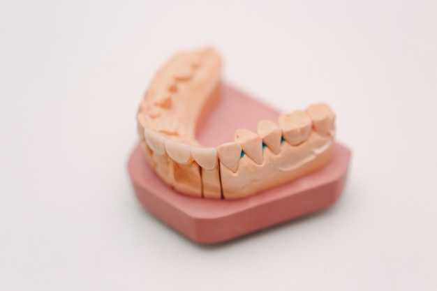 Tandlay-out van de menselijke kaak met tanden en implantaten.