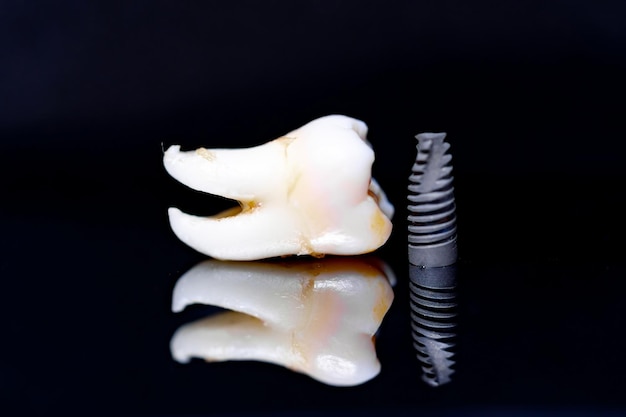 Tandmodel en implantaat op zwarte achtergrond Kunstfoto voor tandconcept