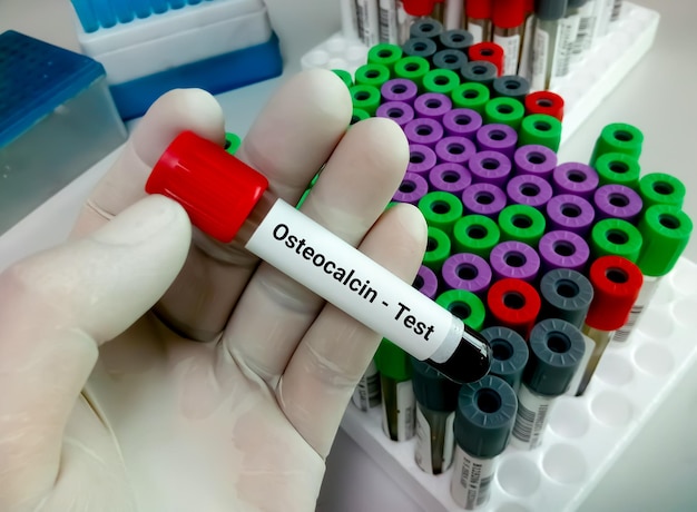 Technicus houdt bloedmonster vast voor botmarker voor osteocalcinetest