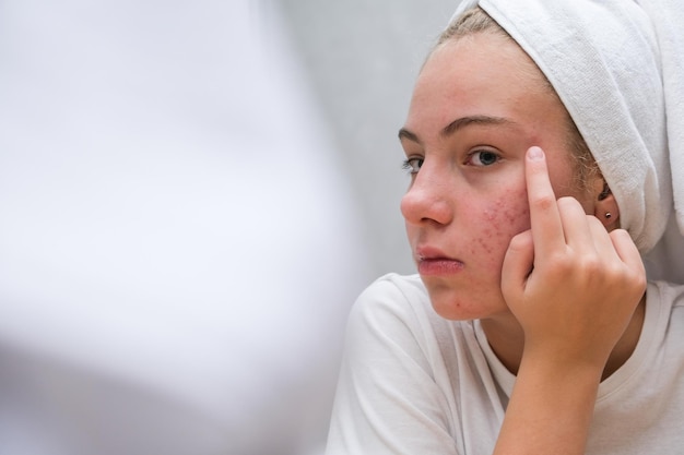 Photo a teenage girl in a white towel on her head is looking at her face with problem skin in the mirror