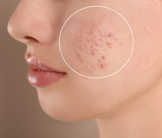 Foto adolescente con problemi di acne su sfondo beige primo piano