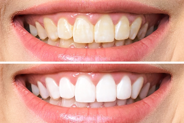 Photo teeth before and after whitening