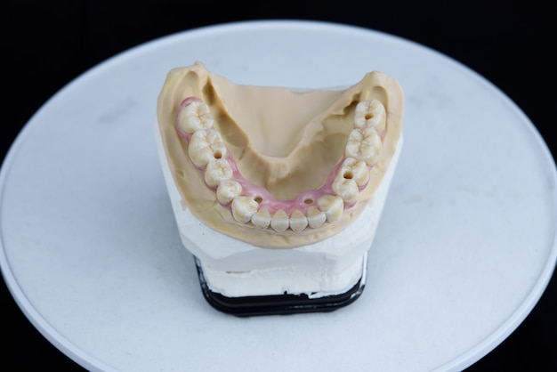 Фото Керамические зубные протезы на печатной акриловой модели в зуботехнической лаборатории. вид сверху.