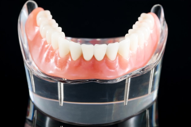 Teeth model showing an implant crown bridge model/ dental demonstration teeth study teach model.