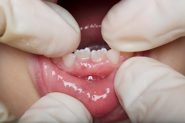 Teeth of six years old child. Closeup