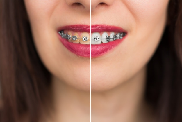 Teeth whitening before after. Woman Teeth Before and After Whitening. Happy smiling woman face close up. Dental health Concept.