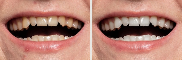 Teeth whitening before and after