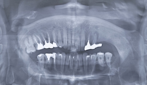 Teeth x-ray image. Scan of teeth