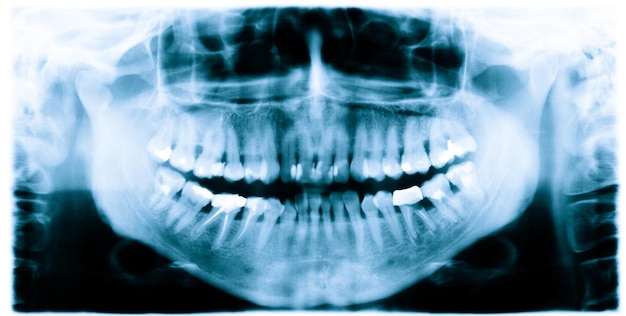 Foto immagine dei raggi x dei denti