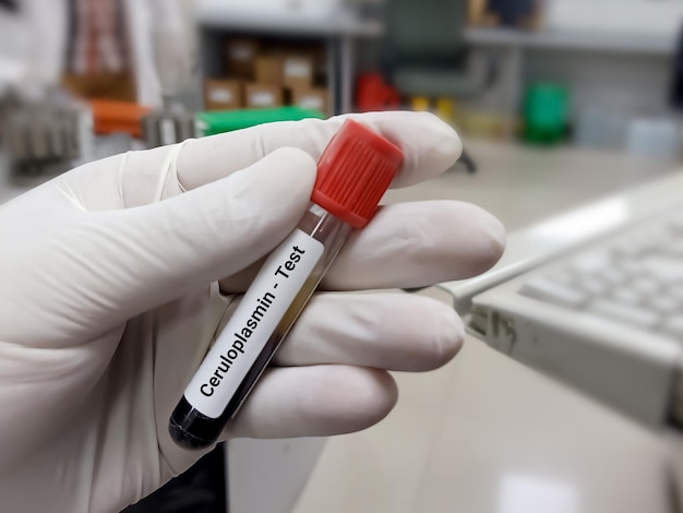 혈액 내 세룰로플라스민 검사 주요 구리 보호 단백질에 대한 혈액 샘플이 포함된 시험관