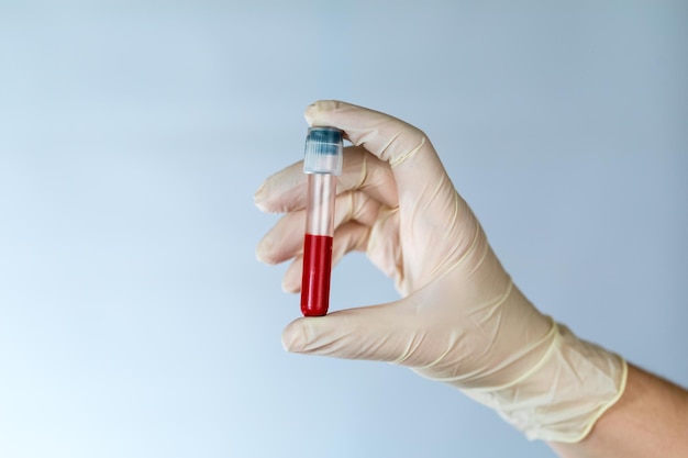 Test tube with a blood sample in the hands of a nurse blood test for viruses in the clinic