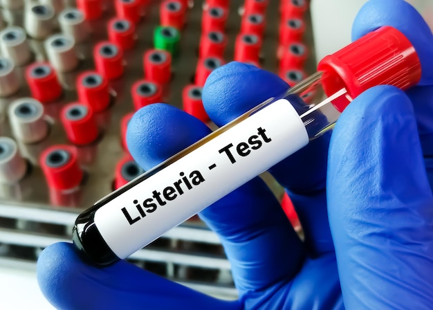 Test tube with blood sample for Listeria bacteria test diagnosis for Listeriosis