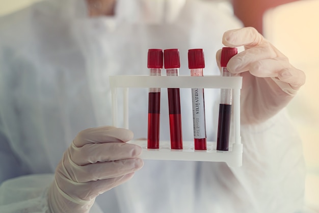 Test tube with patient's blood in the hands of a nurse