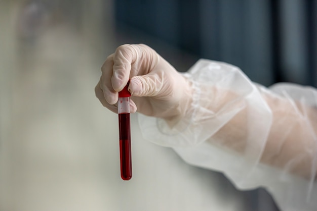 Foto provetta con il sangue del paziente nelle mani di un'infermiera