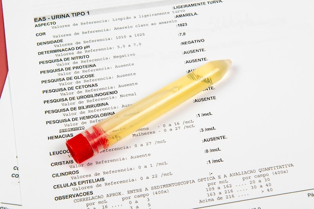 Foto provetta con analisi delle urine su un foglio con i risultati del test