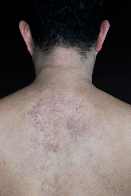 Texture red rash on back man