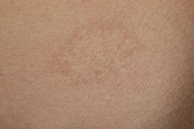 Textuur van de huid met litteken als achtergrond close-up