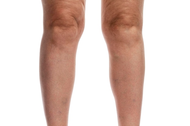 Thick female legs with cellulite and veins. Obesity and disease. Isolated on white background. Close-up.