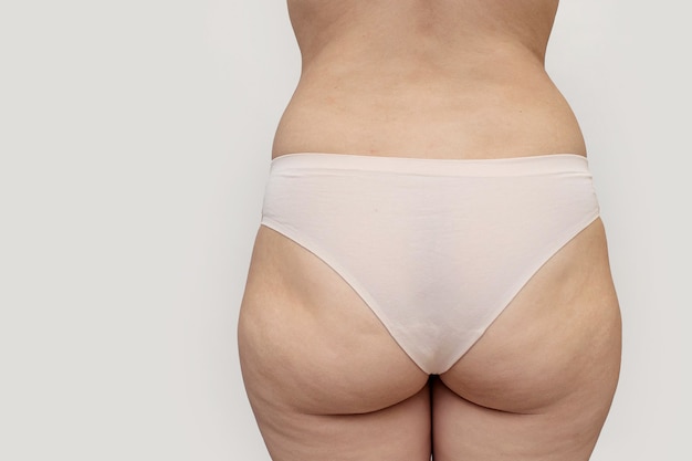 Spesso con la cellulite sulle cosce e sui glutei di una giovane donna