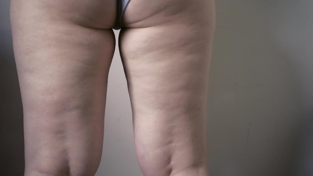 Thigh of a woman with cellulite Figure problem cosmetic massage An overweight girl massages her leg with her hands and checks for cellulite