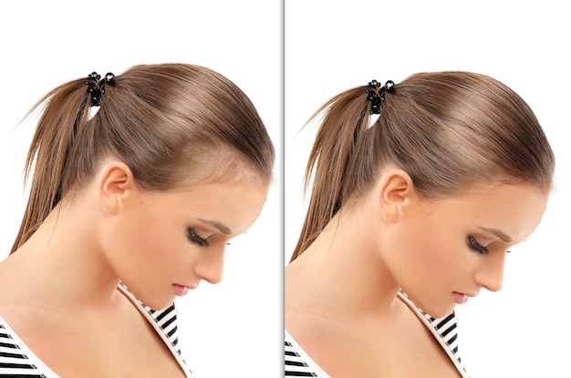 Истончение и выпадение волос Облысение по женскому типу Пересадка волос