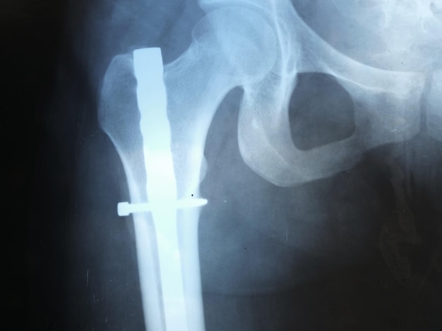 This stock photo shows the Xray of a femur after surgery with the addition of an iron needle after a fracture