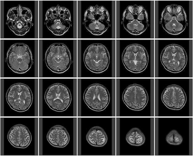 Thumbnail of head MRI