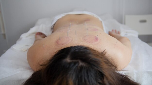 Tibetan medicine - back of a woman after use medical glass procedure, close up