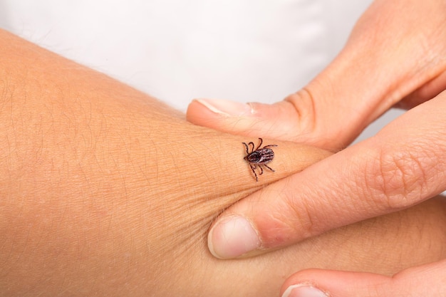 Tick that is biting an arm to a girl