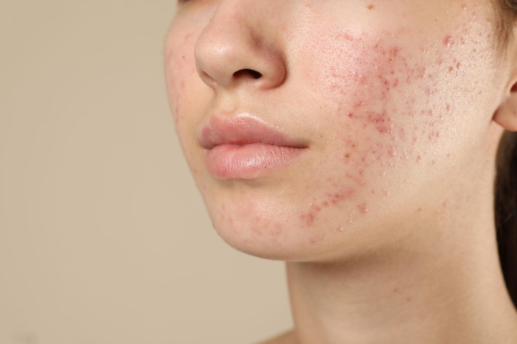 Foto tieners met acne op beige achtergrond close-up