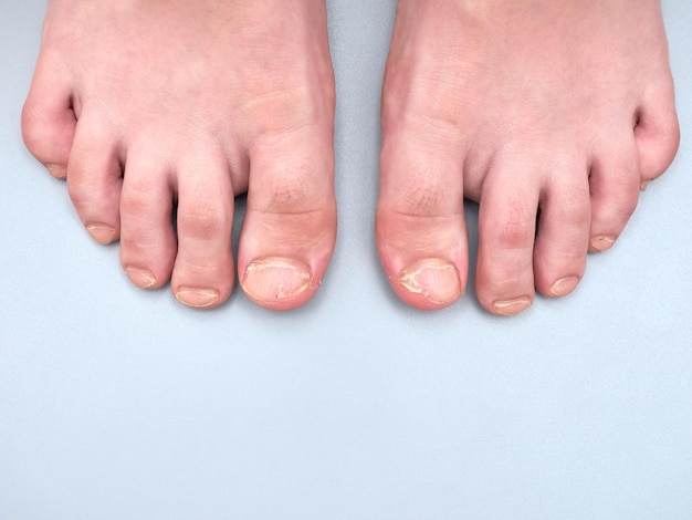 Toenails of a 9 year old boy with a nail disease very weak or brittle nails isolated on gray background