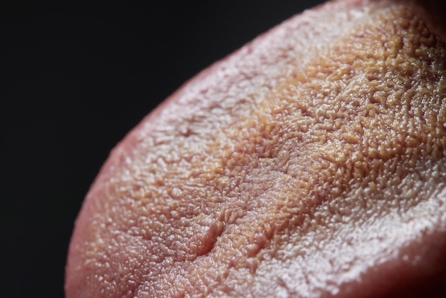 Tong met zweren van volwassen manScheuren in de tong van een jonge manman met halitose voor candida albicans op de tong