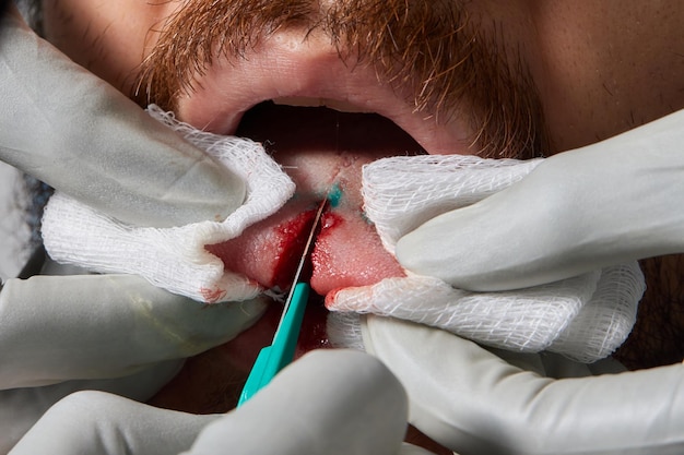 舌を切断する 舌を切断する 人間の身体手術の概念の 改変の一種