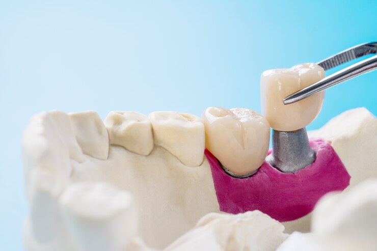 Tooth crown and bridge implant dentistry equipment and model express fix restoration.