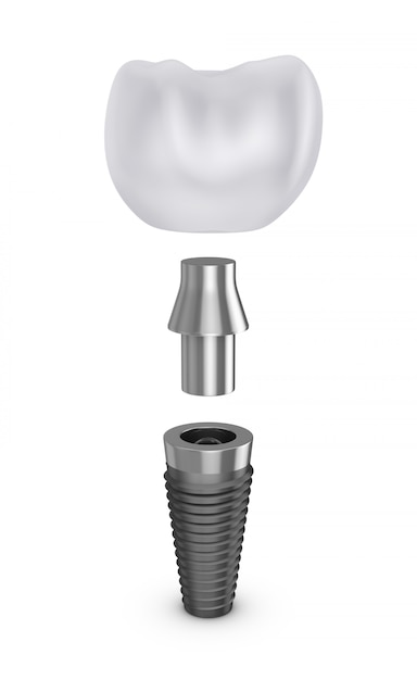 Tooth implant in disassembled form. 