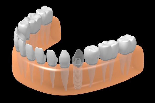 歯のインプラントと歯肉の健康なものの 3 D イラストレーション