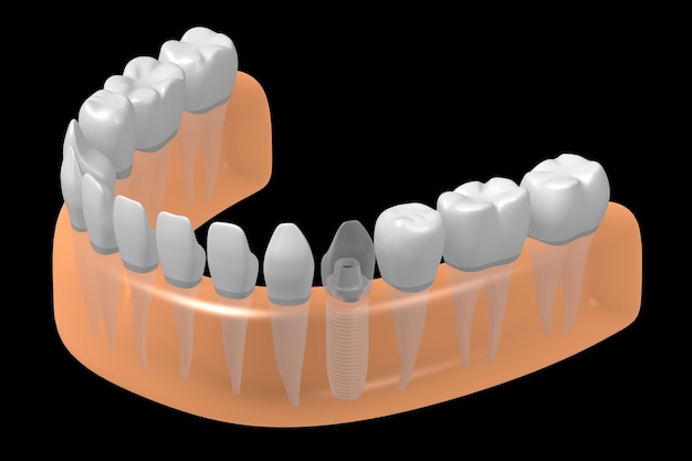 잇몸 3D 일러스트레이션의 치아 임플란트 및 건강한 것들